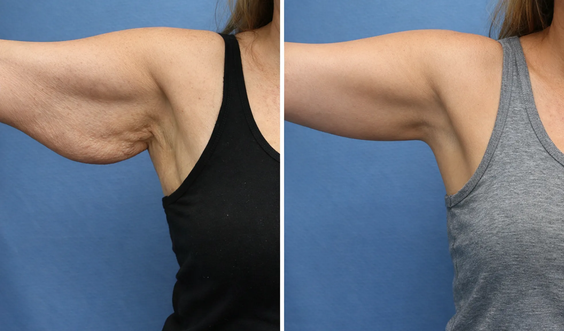 Flabby Arms Cause